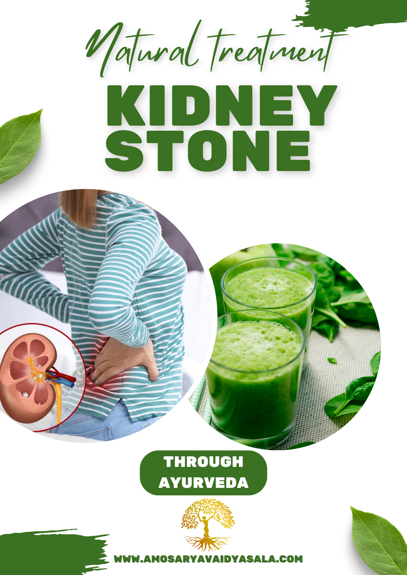 Kidney stone treatment